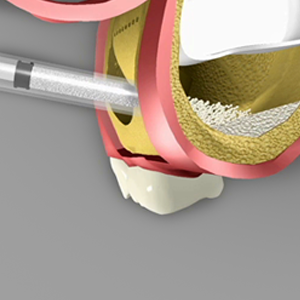 Sinus Grafts as an example of oral surgery in Cary NC